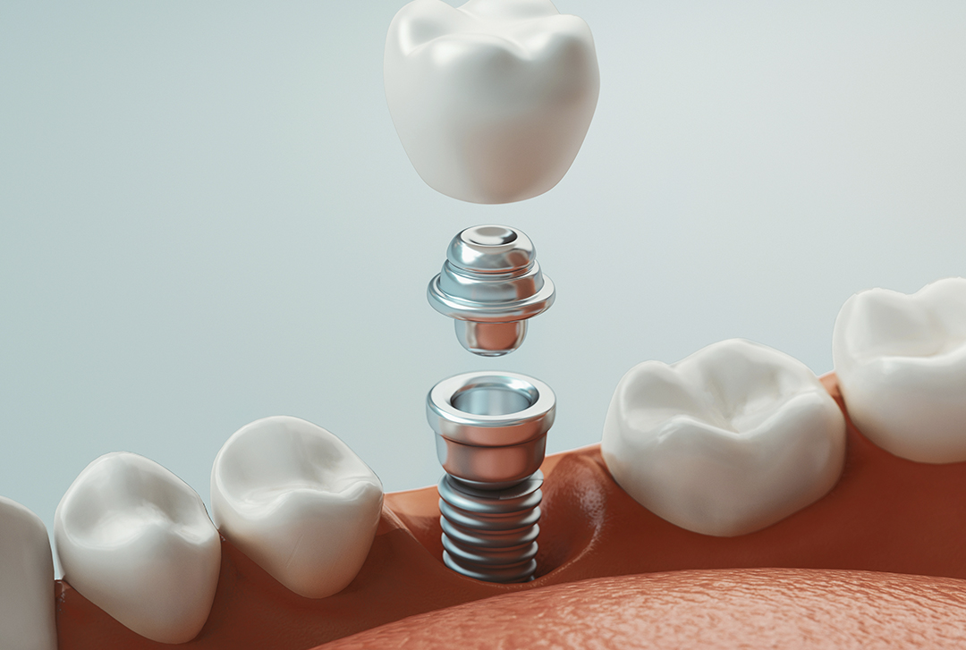 Implantes dentales